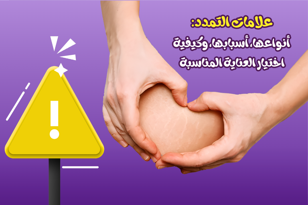 علامات التمدد: أنواعها، أسبابها، وكيفية اختيار العناية المناسبة